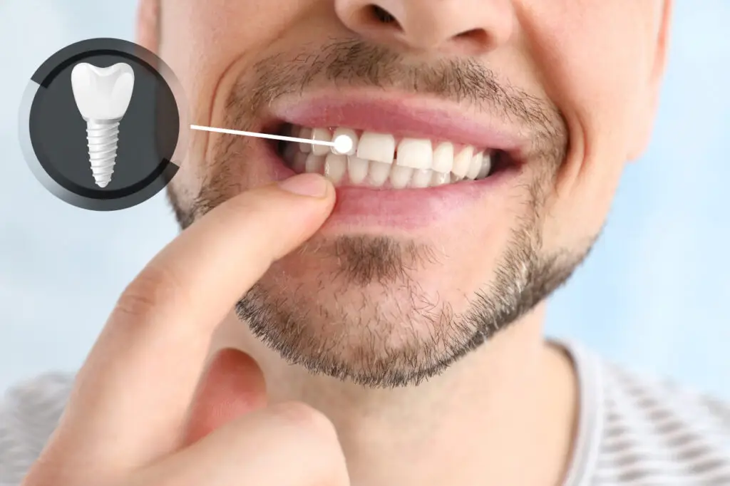 Are Dental Implants Worth It? Comparing the Long-Term Value of Tooth Replacement Options
