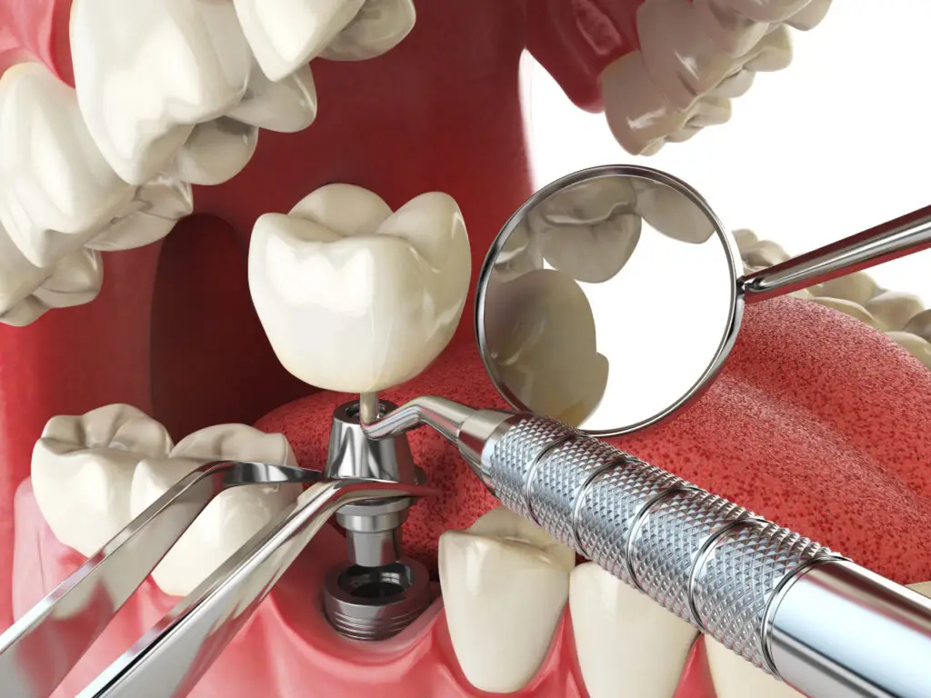 What Is the Dental Implant Process? A Step-by-Step Guide for Phoenix Patients