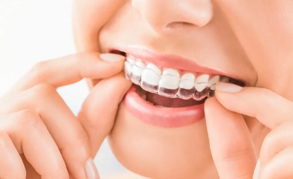 How Do Clear Aligners Work? A Phoenix Patient’s Guide to Straighter Teeth