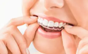 How Do Clear Aligners Work? A Phoenix Patient’s Guide to Straighter Teeth