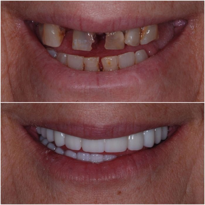 Implant Dentures before-and-after case 1