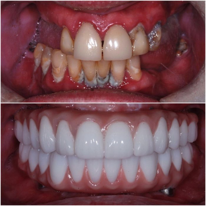 Implant Dentures before-and-after case 2