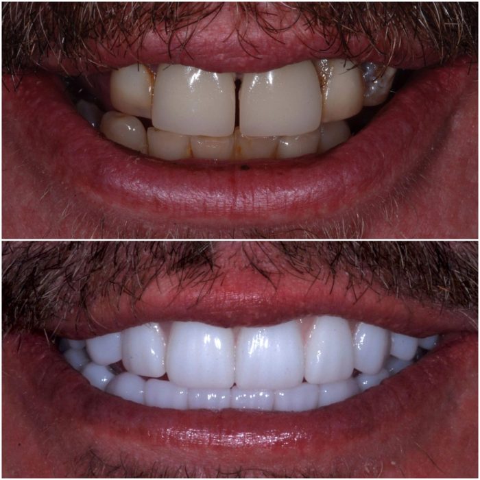 Implant Dentures before-and-after case 3