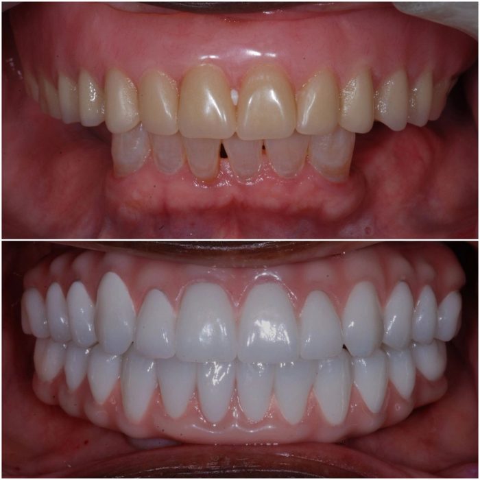 Implant Dentures before-and-after case 4