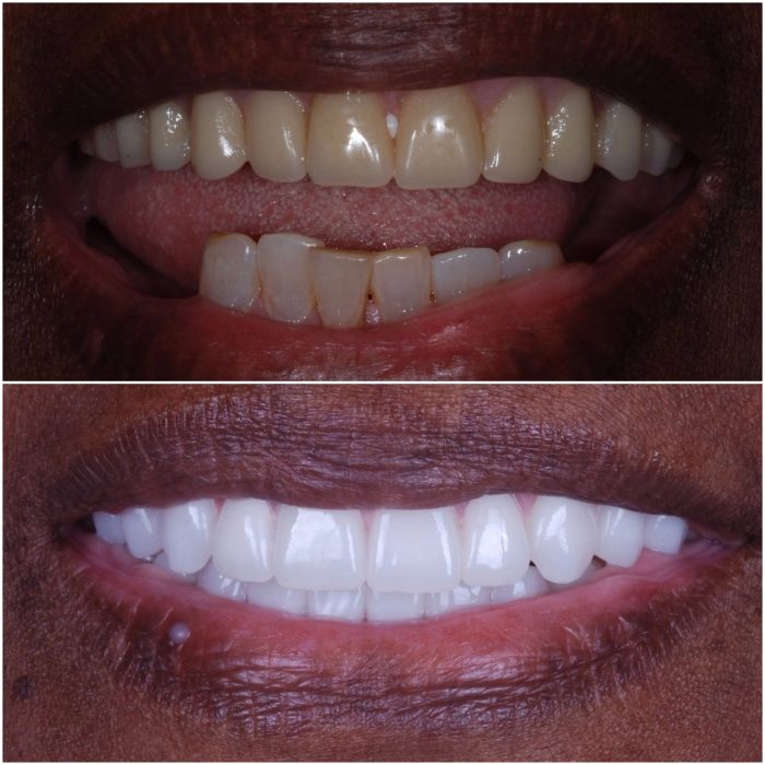 Implant Dentures before-and-after case 5