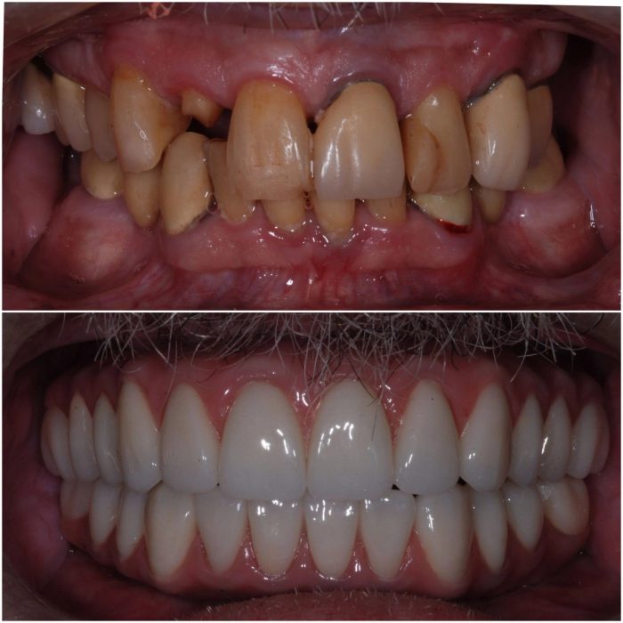 Implant Dentures before-and-after case 6