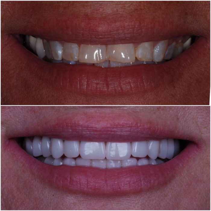 Implant Dentures before-and-after case 7