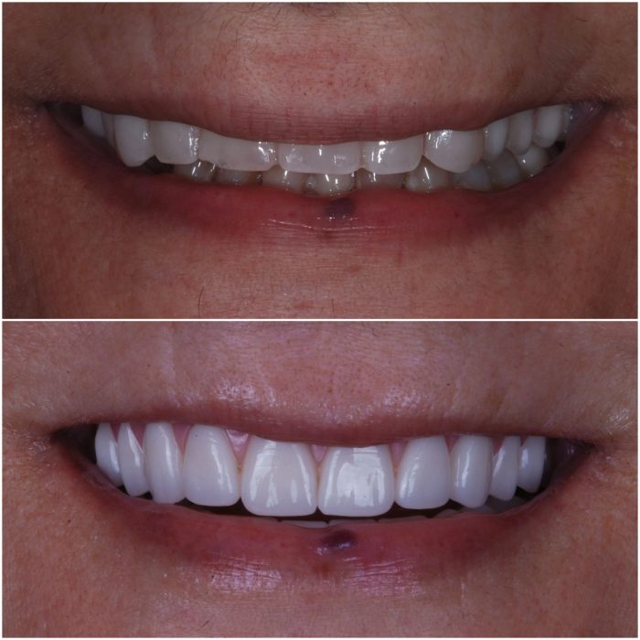 Implant Dentures before-and-after case 8