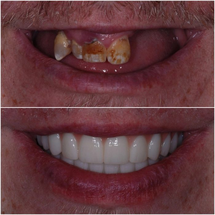 Implant Dentures before-and-after case 9
