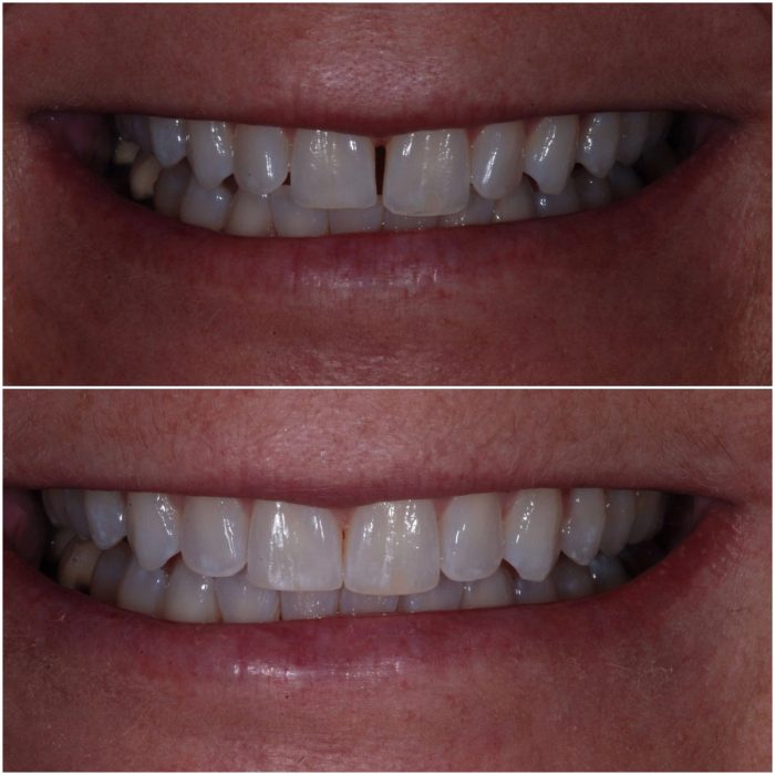 Invisalign before-and-after case 1