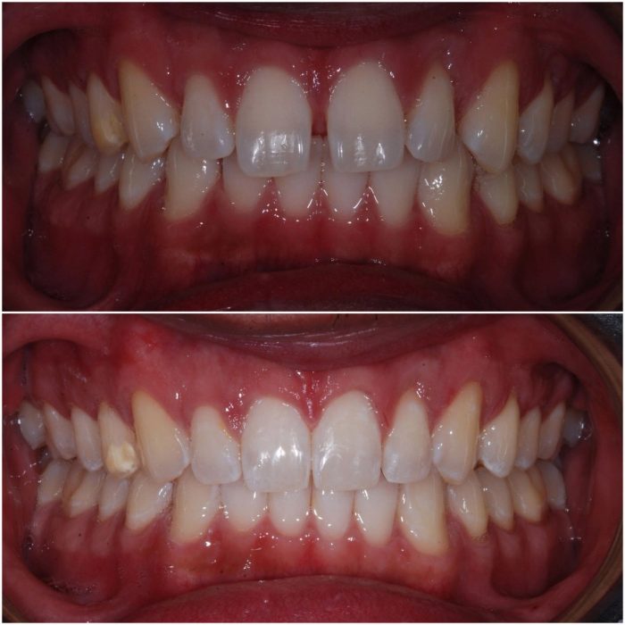 Invisalign before-and-after case 2