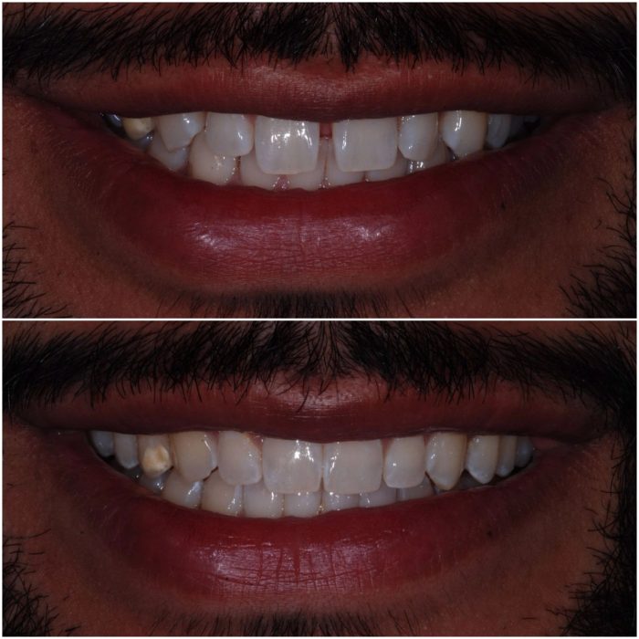 Invisalign before-and-after case 3