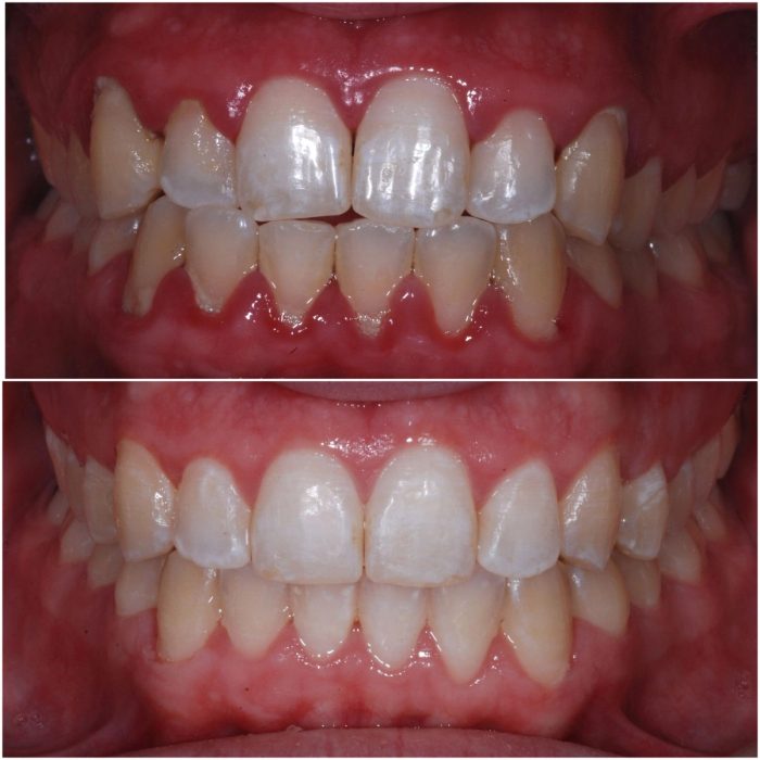 Invisalign before-and-after case 4