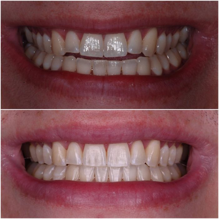 Invisalign before-and-after case 5