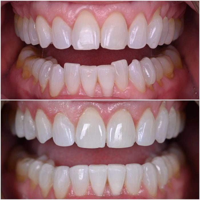 Invisalign before-and-after case 6
