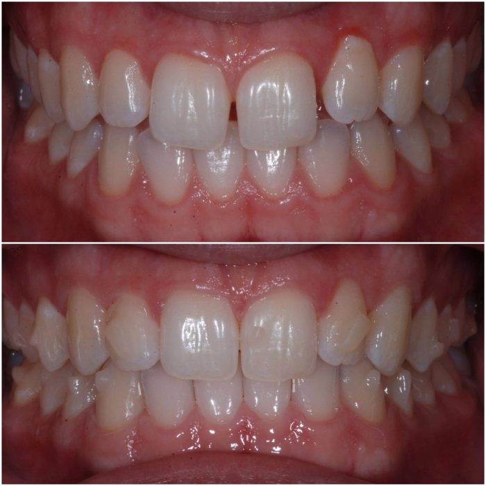 Invisalign before-and-after case 7