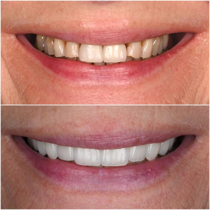 Smiles before-and-after case 1