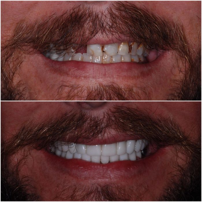 Smiles before-and-after case 2