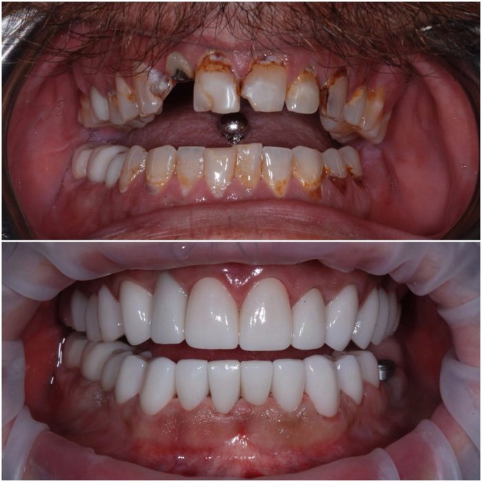 Smiles before-and-after case 3