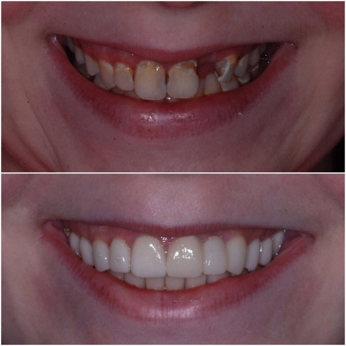 Smiles before-and-after case 4