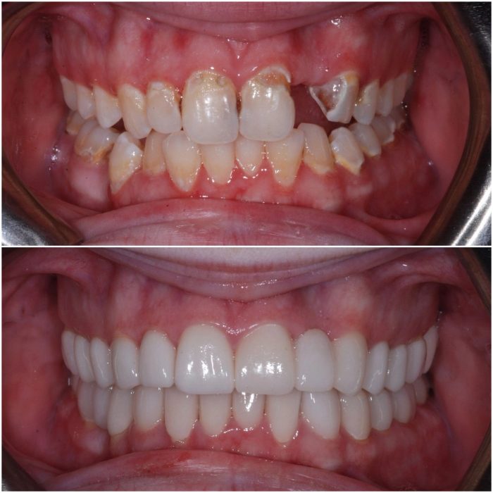 Smiles before-and-after case 5