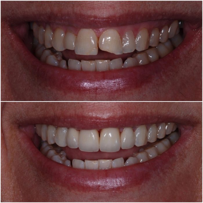 Smiles before-and-after case 6