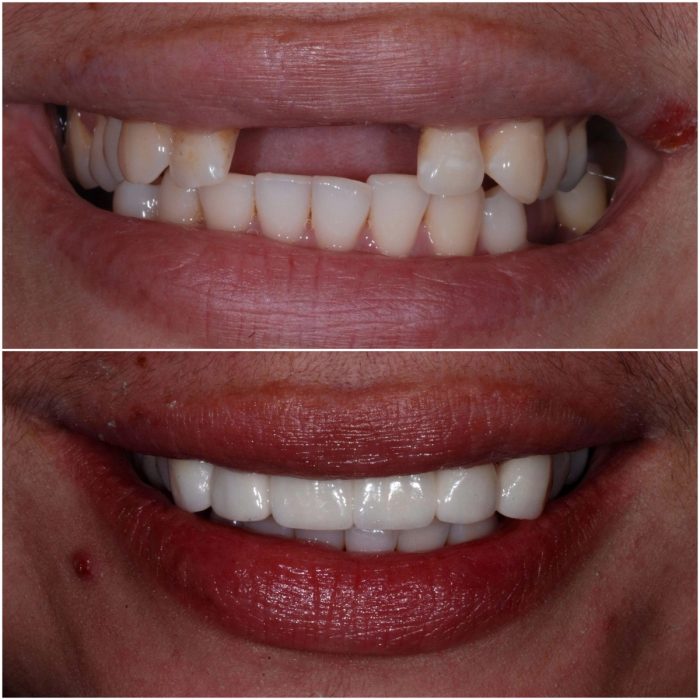 Smiles before-and-after case 7