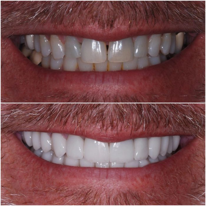 Smiles before-and-after case 8