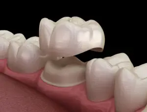 Same-Day Dental Crowns in Phoenix, AZ: Restore Your Tooth in One Visit